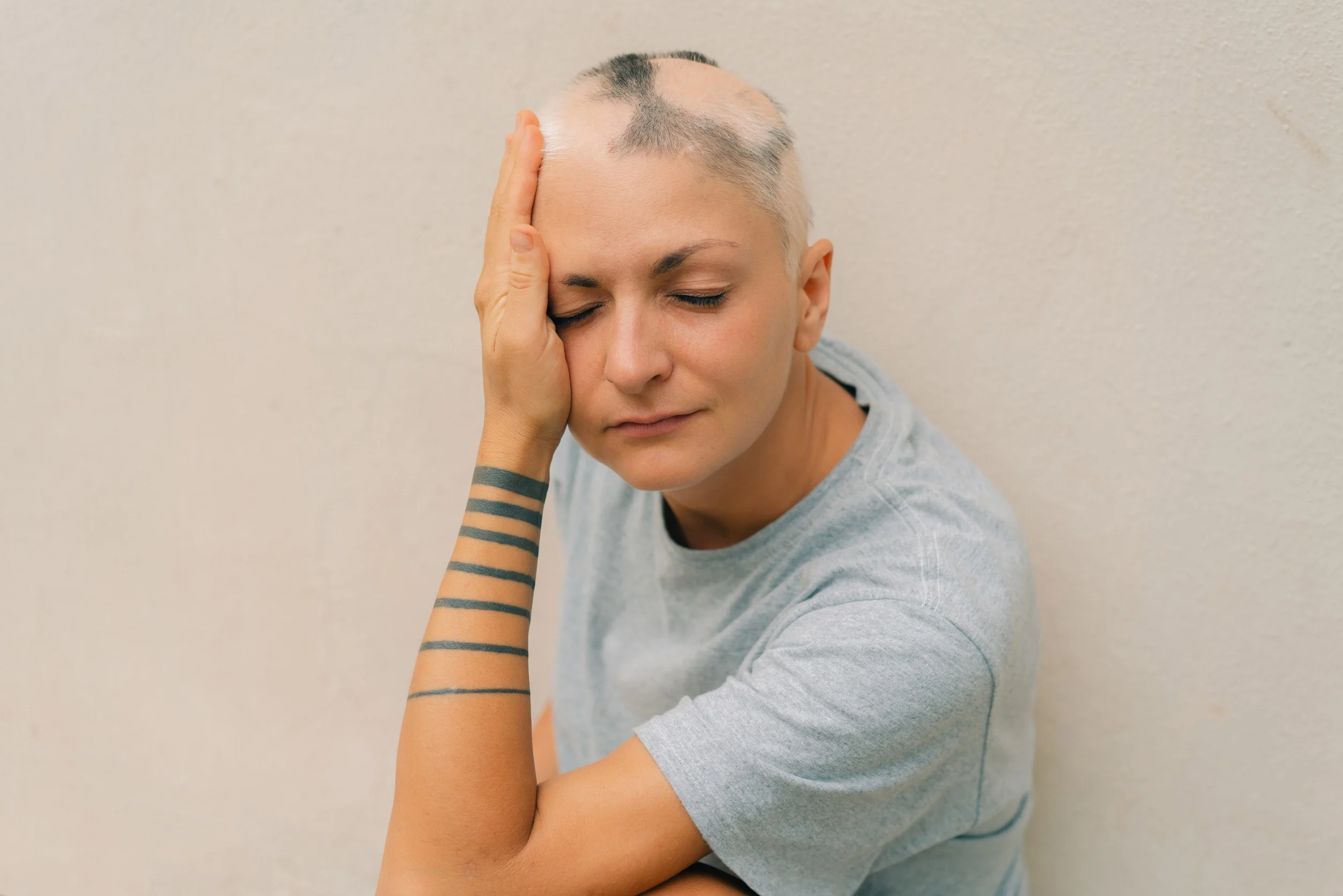 Una donna affetta da alopecia diffusa