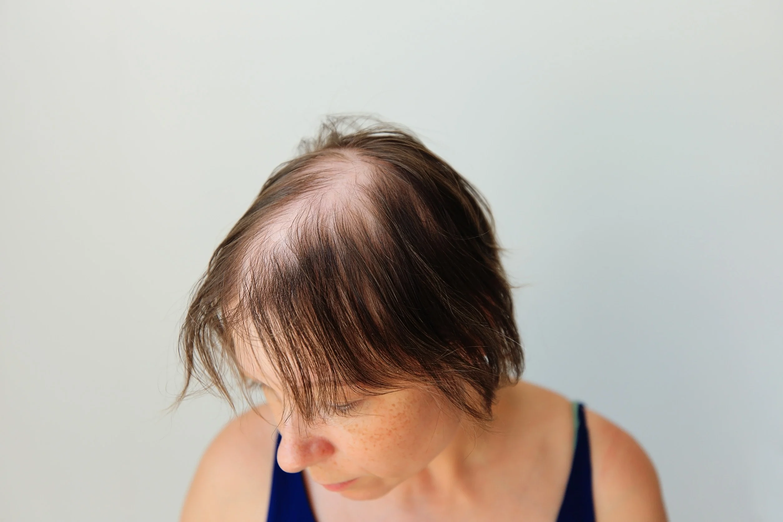 Una donna giù di morale per via dell'alopecia