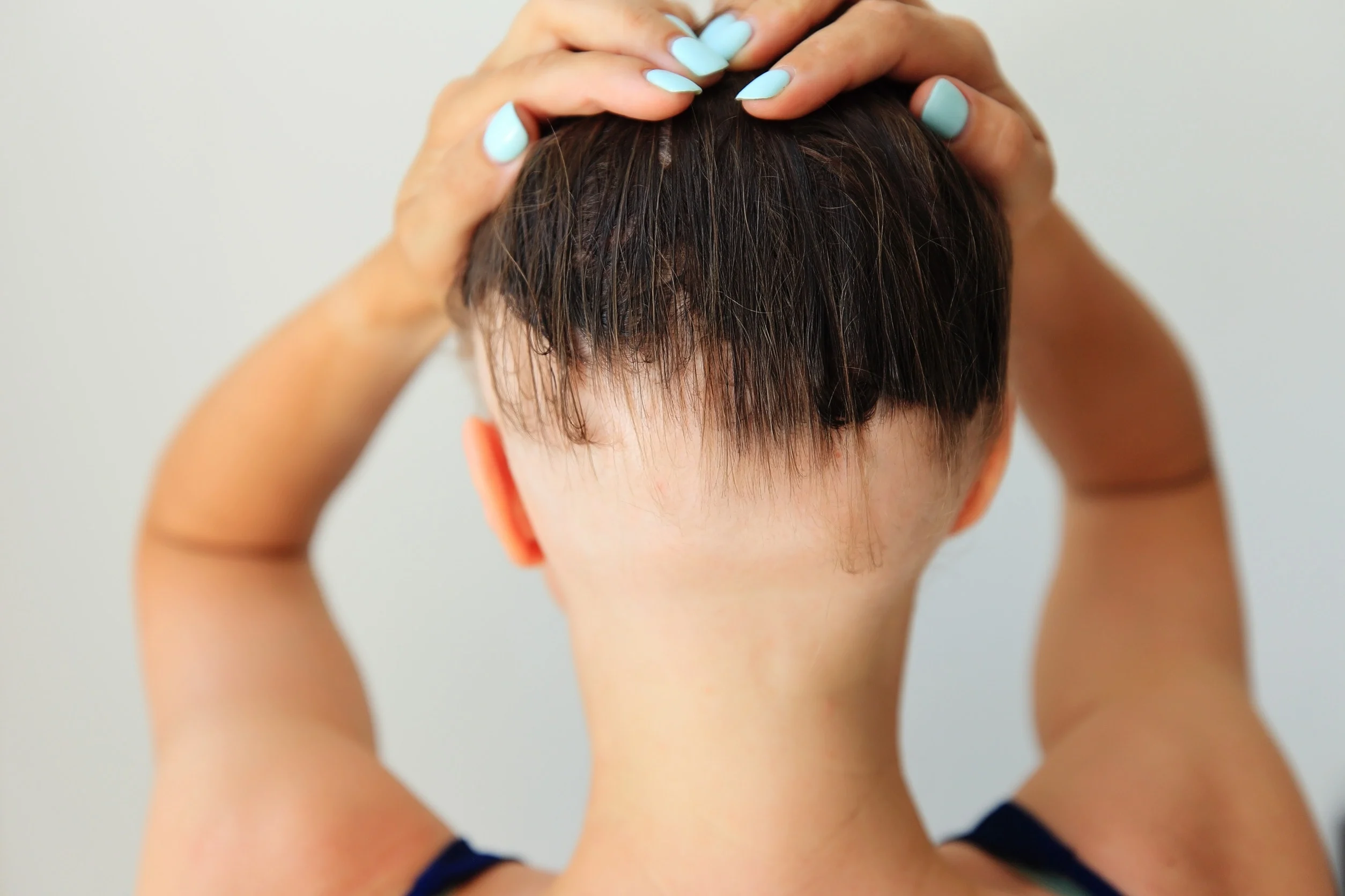 Una donna affetta da alopecia areata