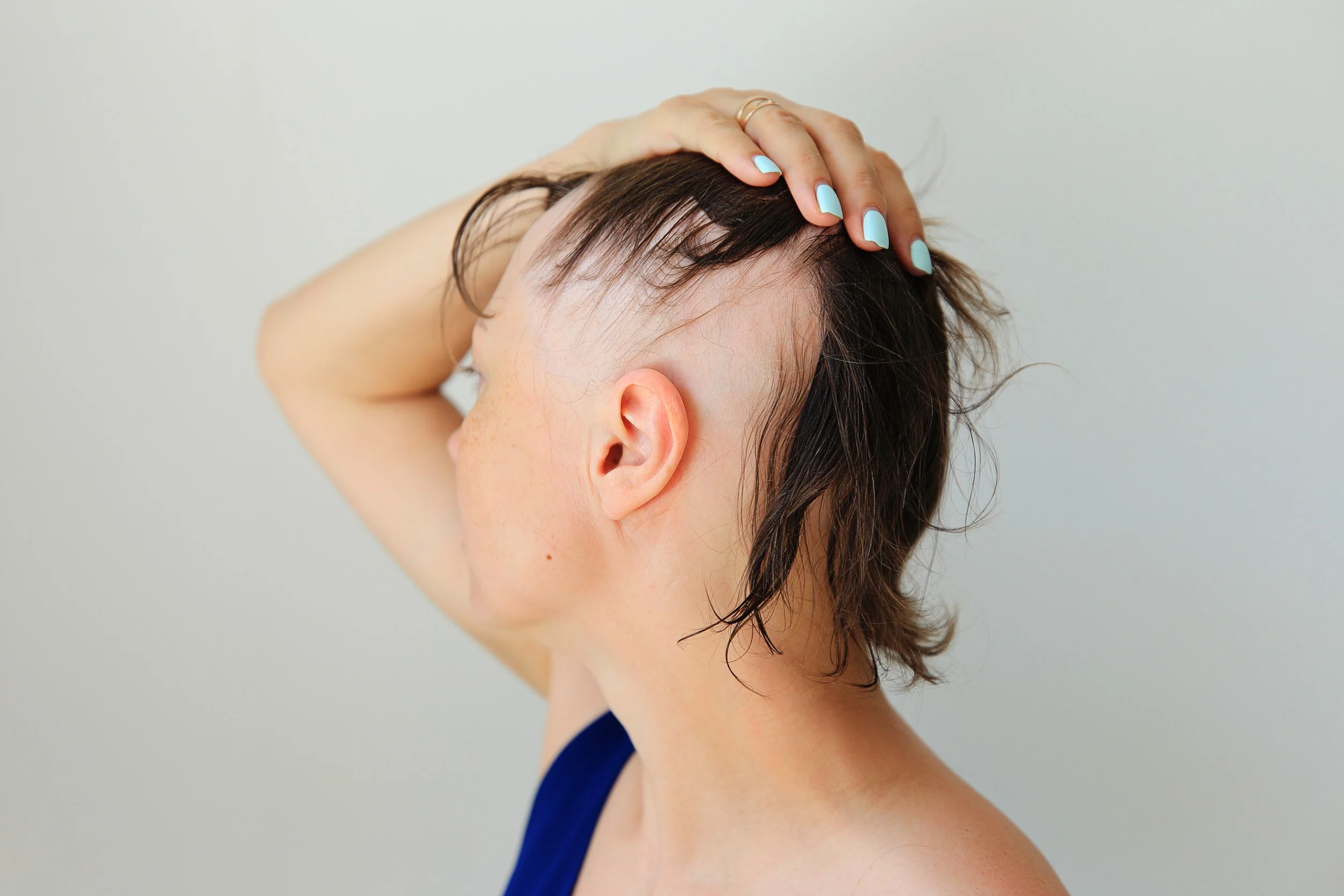 I segni di una alopecia femminile di tipo grave.