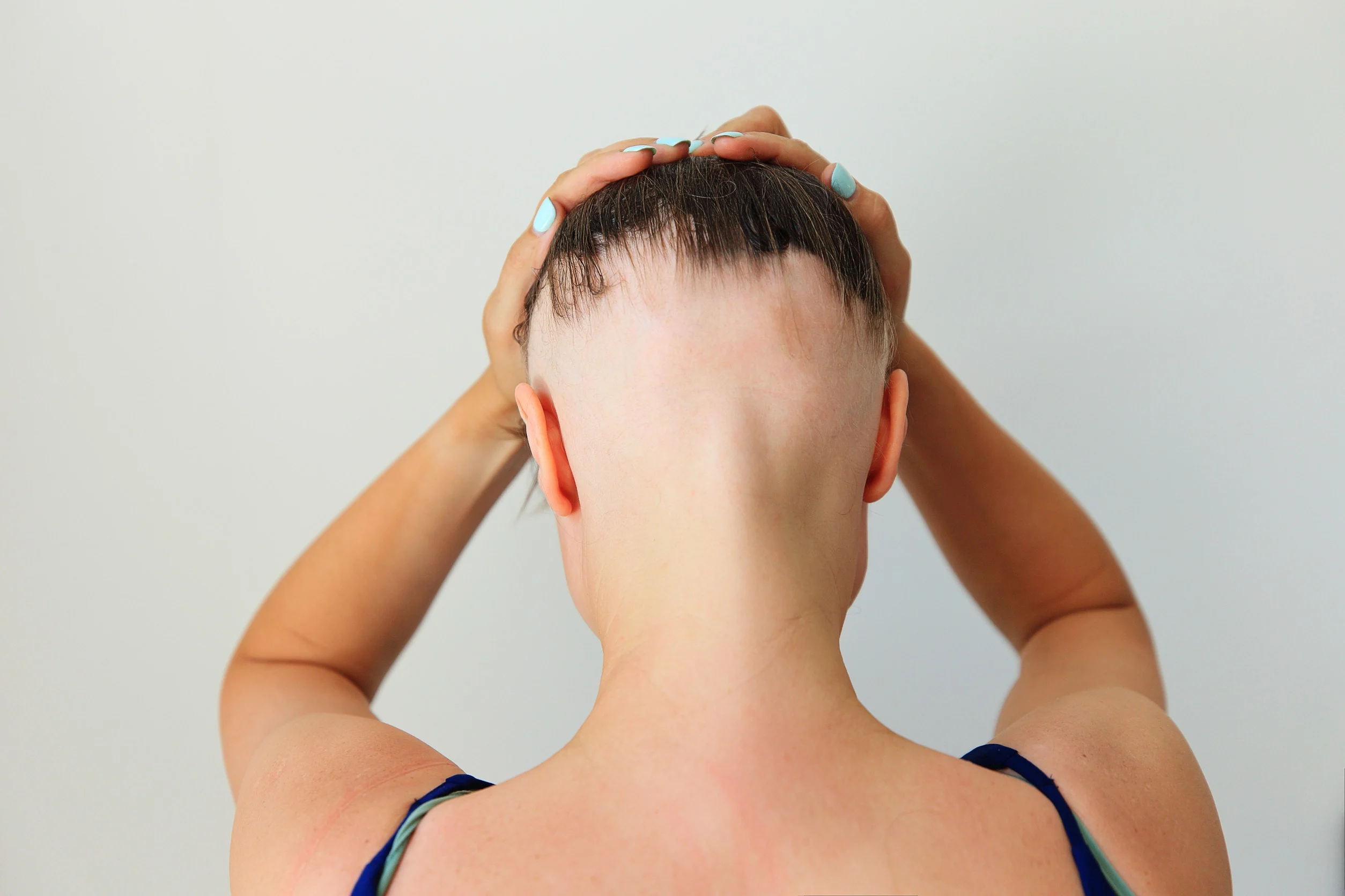 Una donna affetta da alopecia dietro la nuca