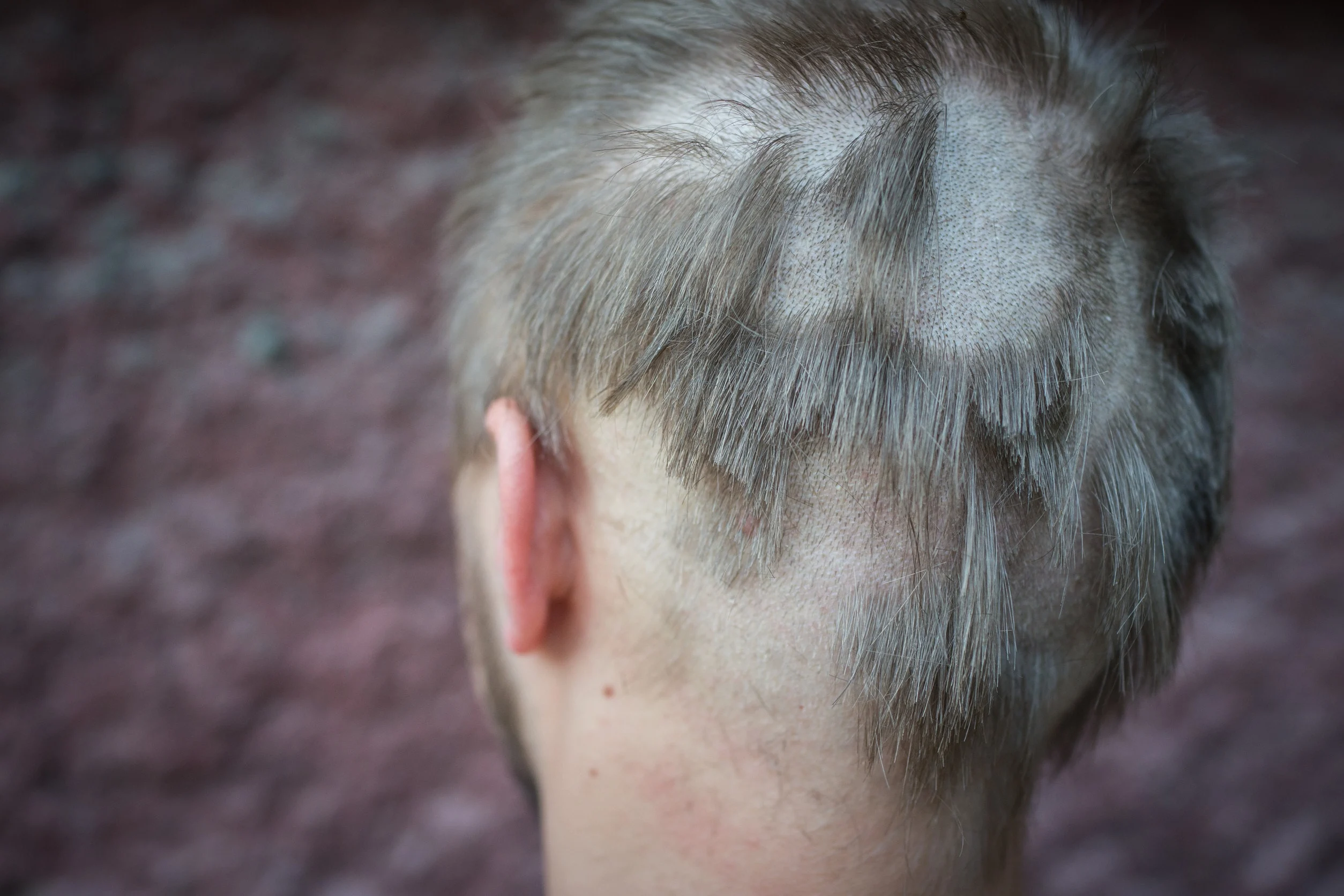 Un caso molto grave di alopecia dietro la nuca