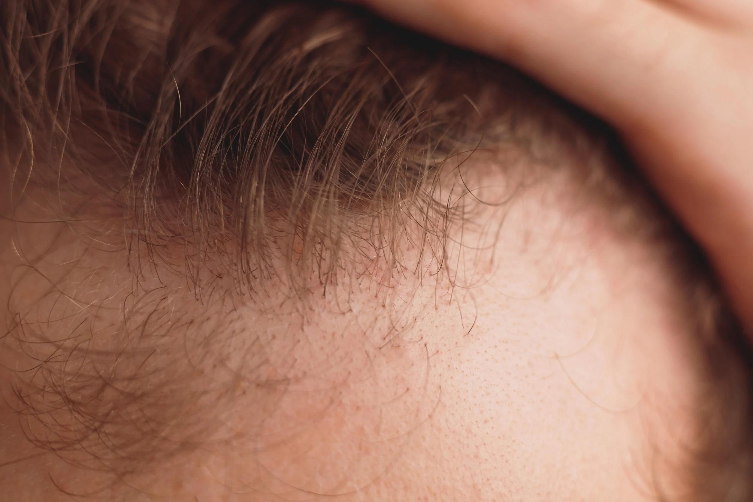 Immagine che rappresenta una testa maschile con capelli diradati, simbolo dell'alopecia androgenetica.