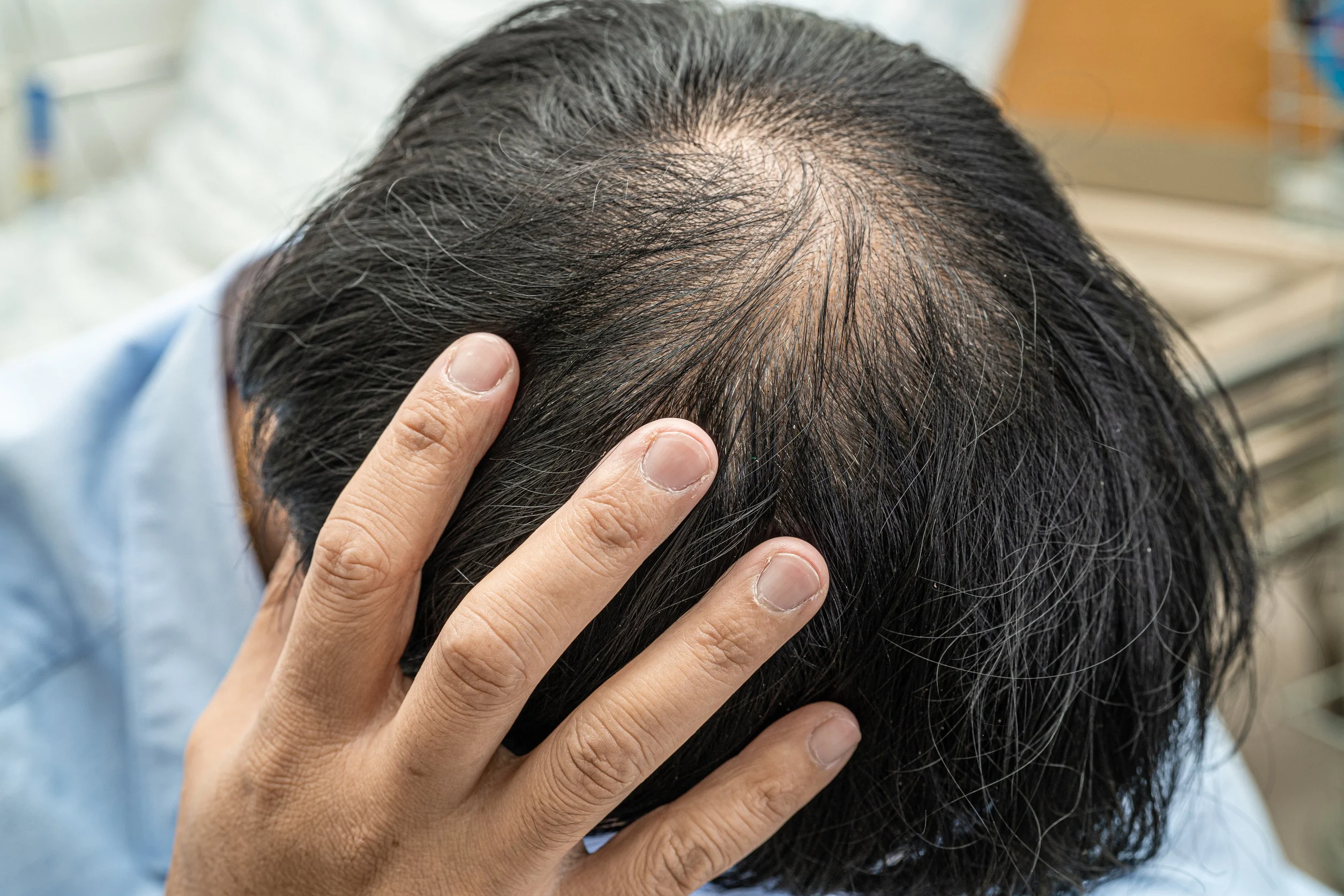 Immagine che mostra i sintomi iniziali dell'alopecia androgenetica, con capelli diradati.