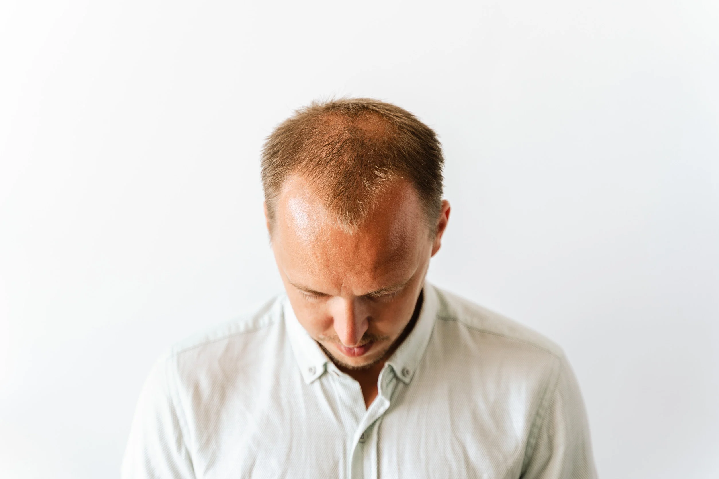 Un uomo con i primi segni di alopecia