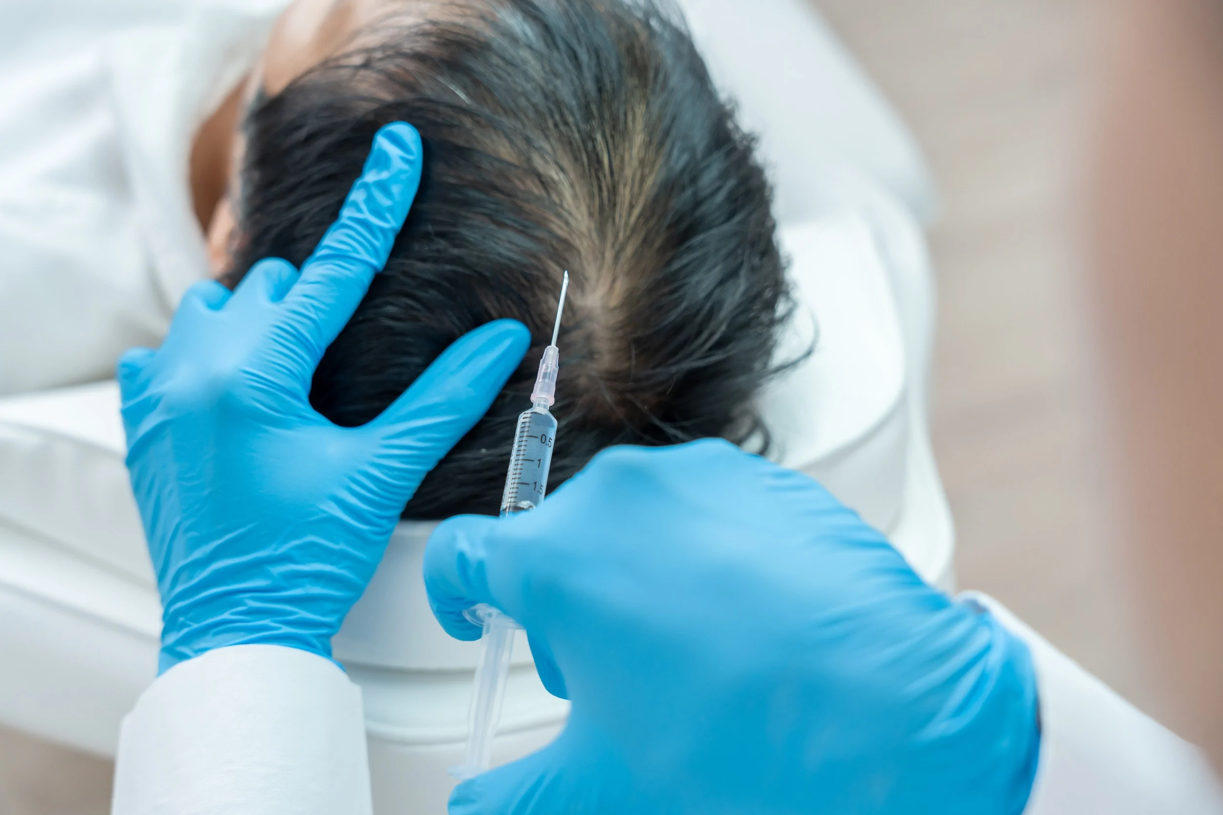 Un paziente riceve delle cellule staminali per il trapianto di capelli