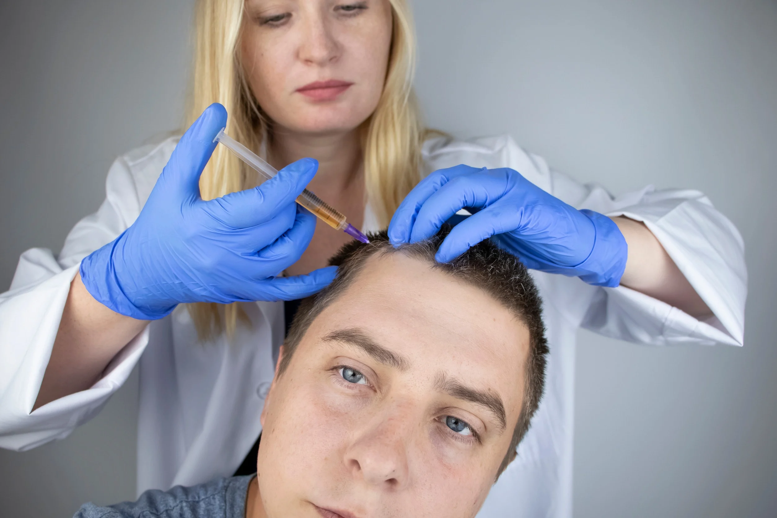 Un uomo che ha beneficiato di un trapianto di capelli con cellule staminali