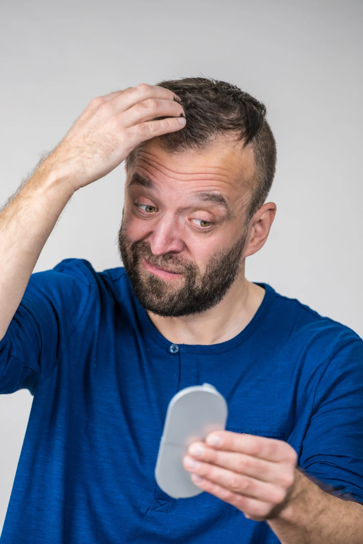 Un uomo combattuto dall'alopecia alle tempie