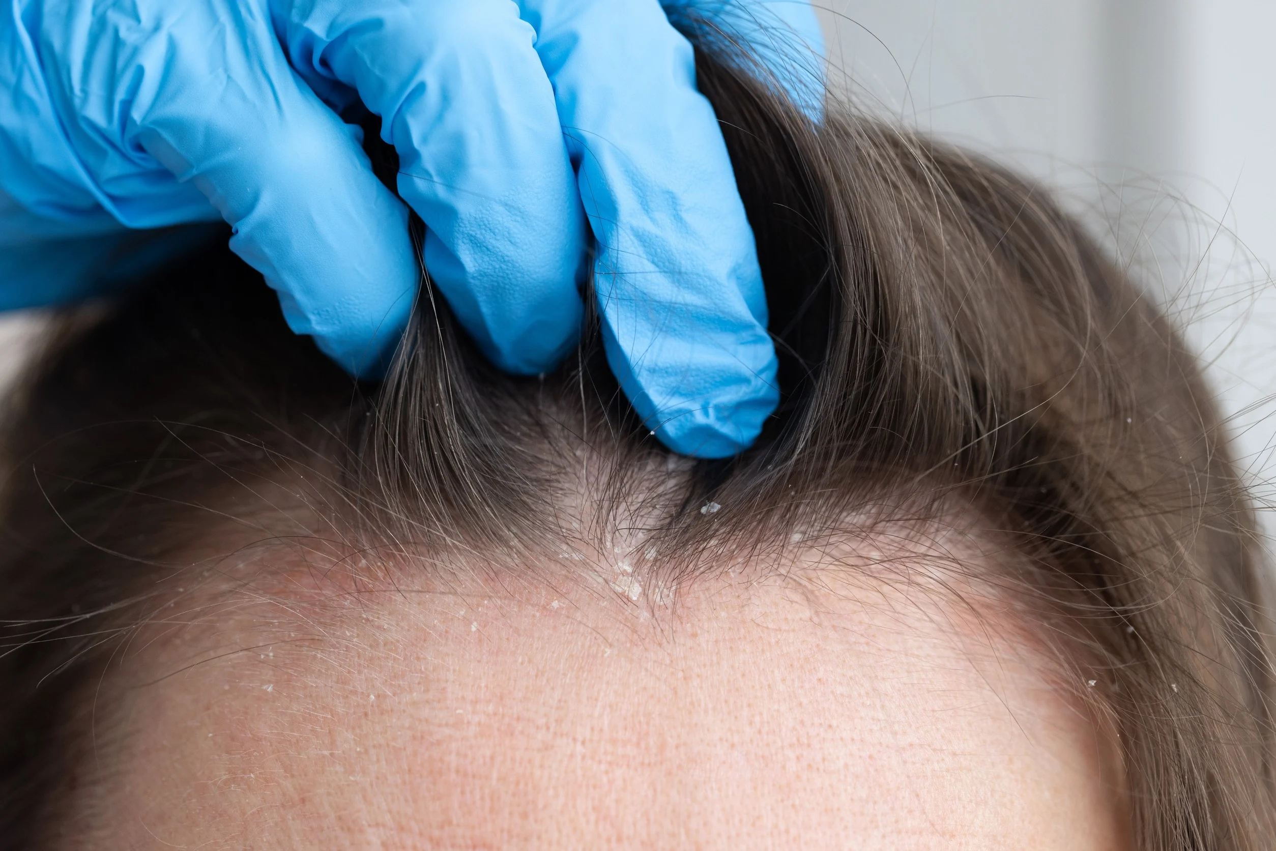 Uno specialista esamina il cuoio capelluto di un paziente che ha notato l'aumento di capelli assottigliati.