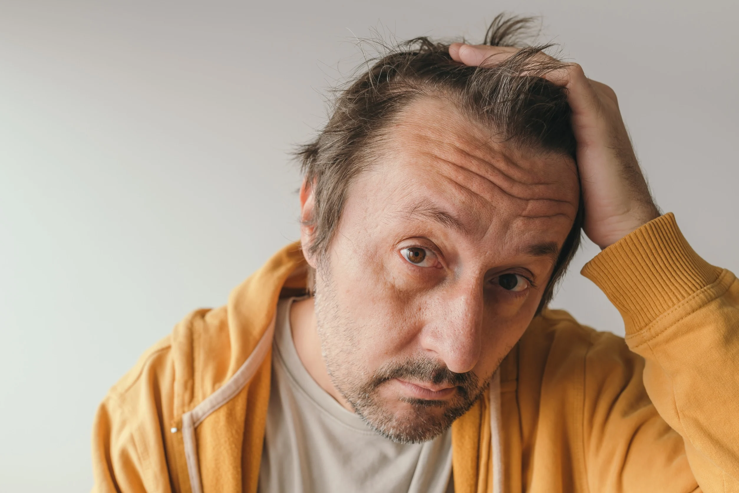 Un uomo preoccupato dalla stempiatura