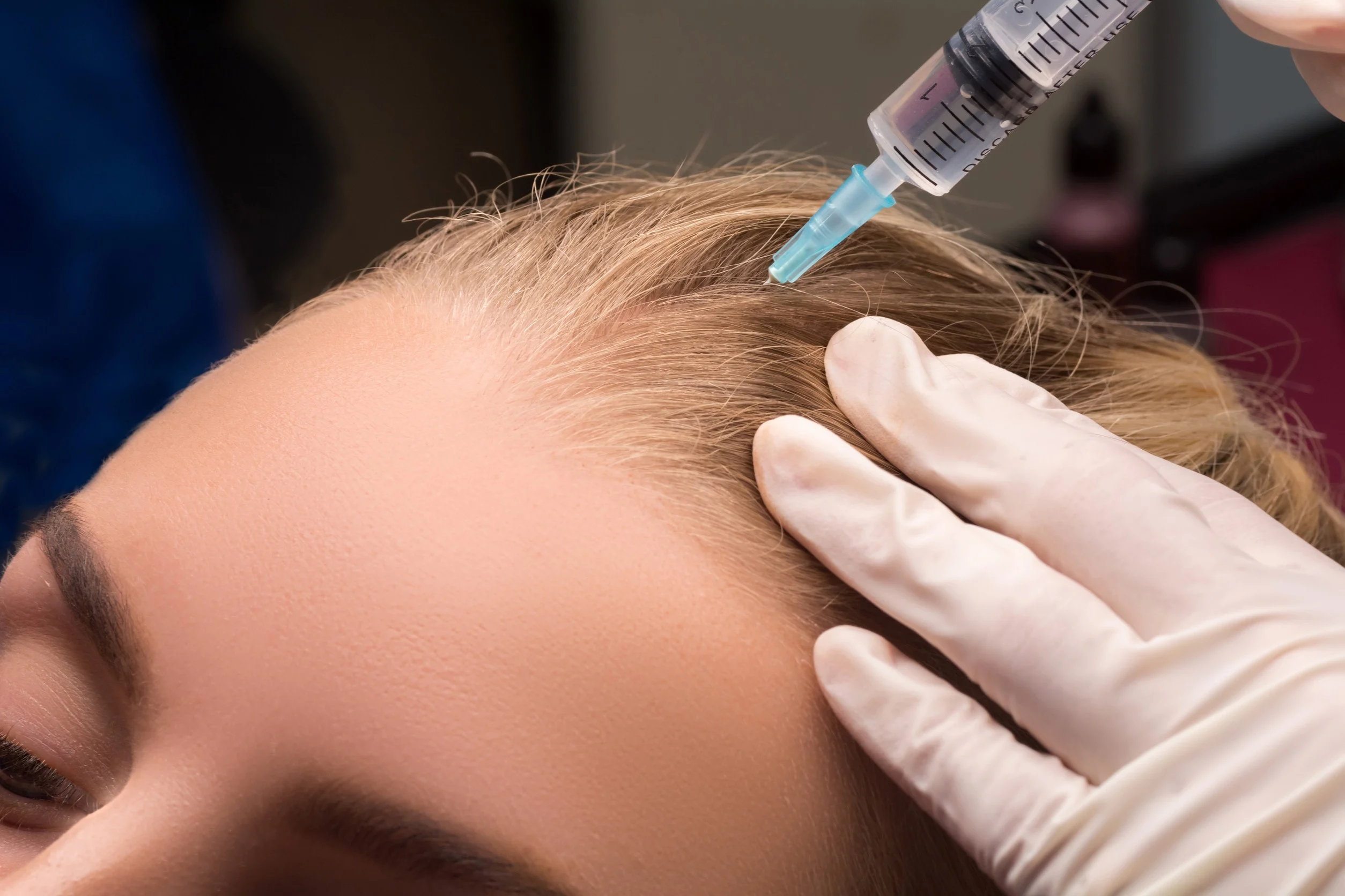 Una fase del trattamento PRP per capelli